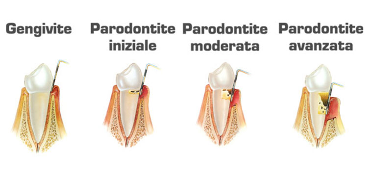 parodontologia-studio-marconi