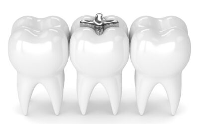 Otturazioni dentali al mercurio.