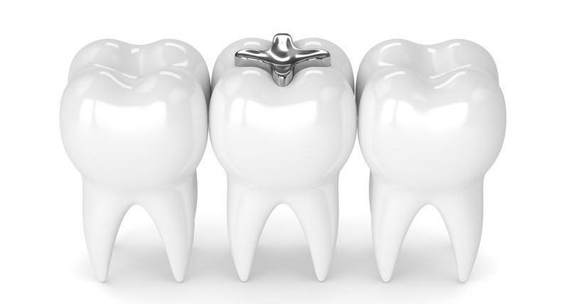 otturazioni dentali