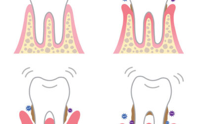 Un possibile legame tra parodontite e alcune tipologie di tumore
