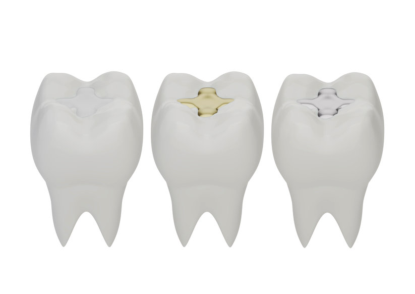 Materiali per le otturazioni dentali