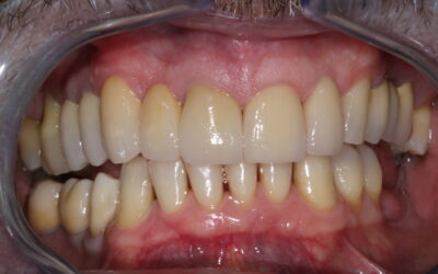 Protesi fissa su elementi dentali