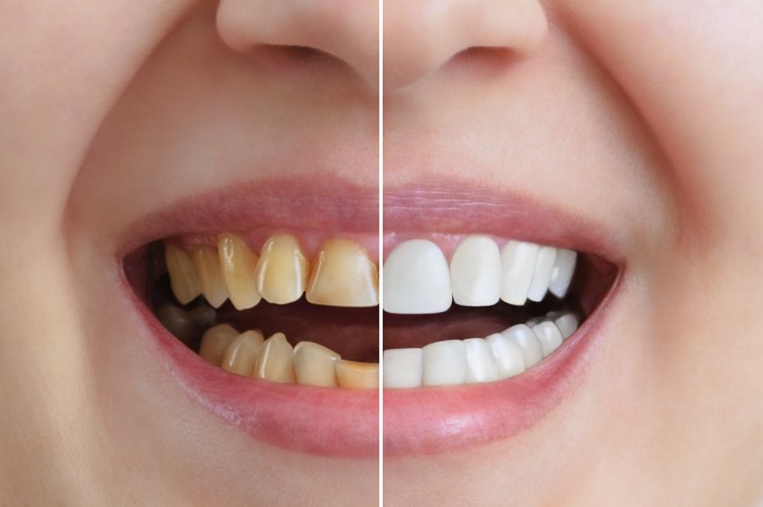 Tipologie di sbiancamento dei denti