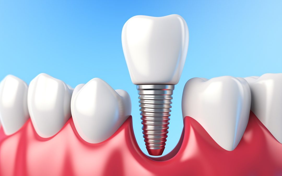 L’importanza dei materiali biocompatibili in odontoiatria