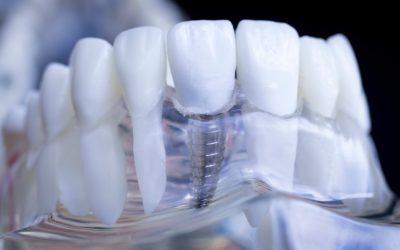 Impianto dentale e osso mascellare