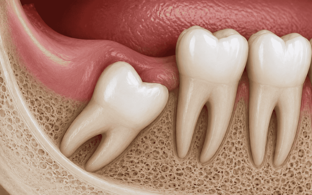 Dente del giudizio che non esce a 40 anni: sintomi, rischi e quando intervenire